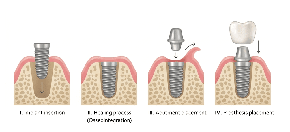 Step-by-step dental implant procedure diagram