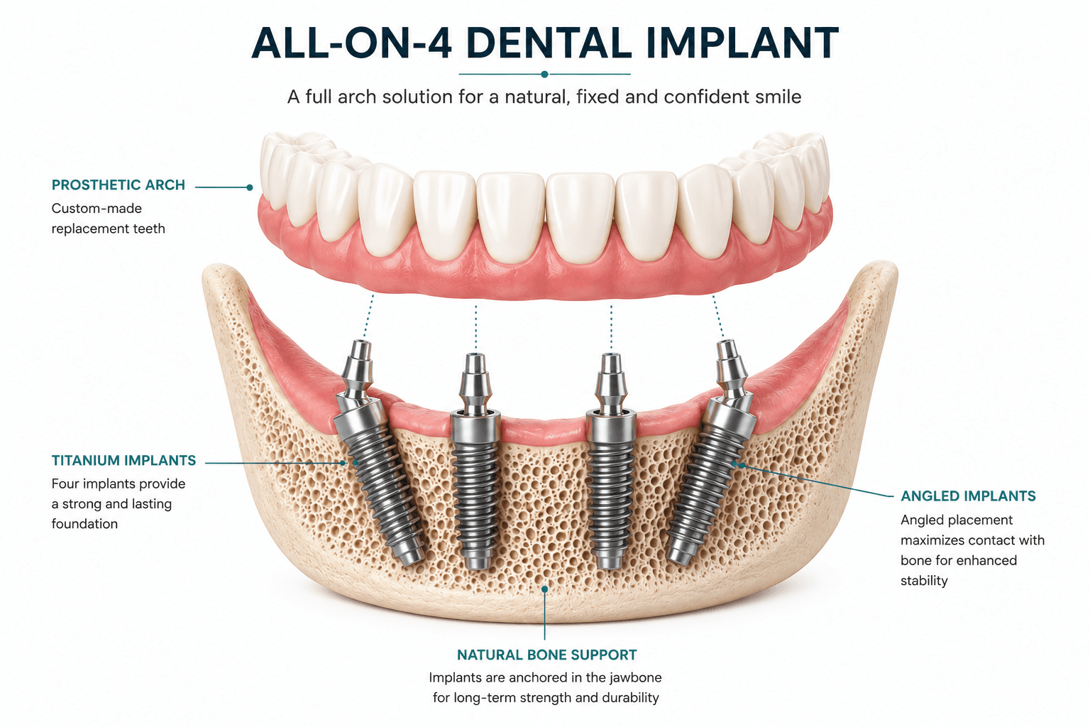 All-on-4 dental implant illustration