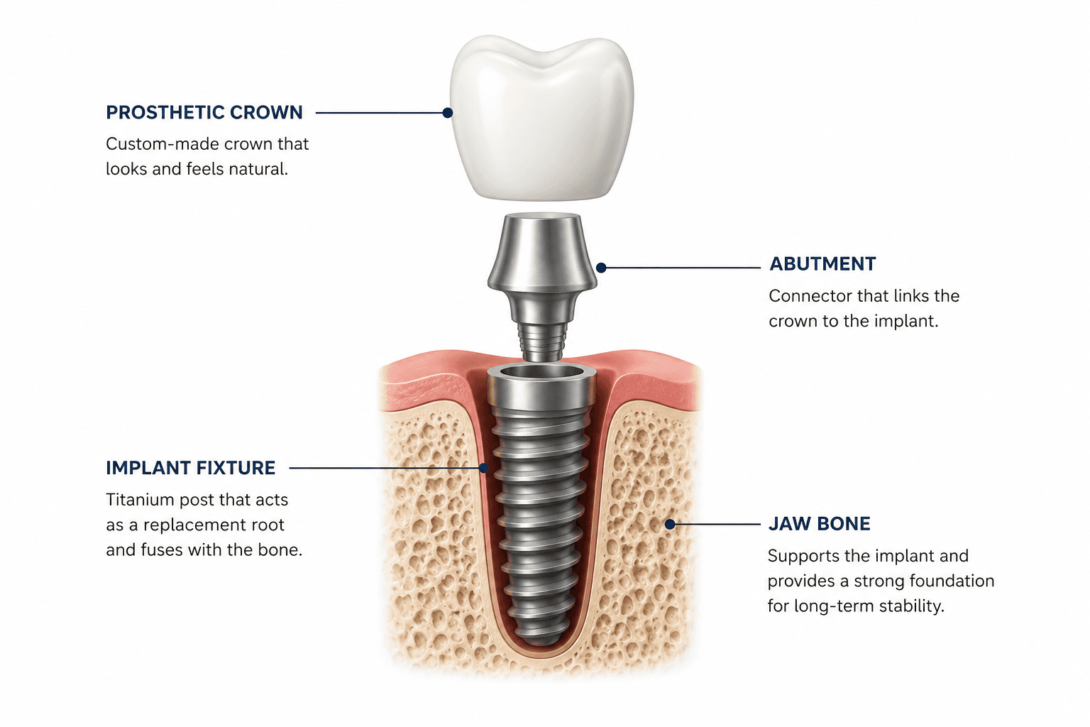 Dental implant part diagram - crown, abutment, implant, bone